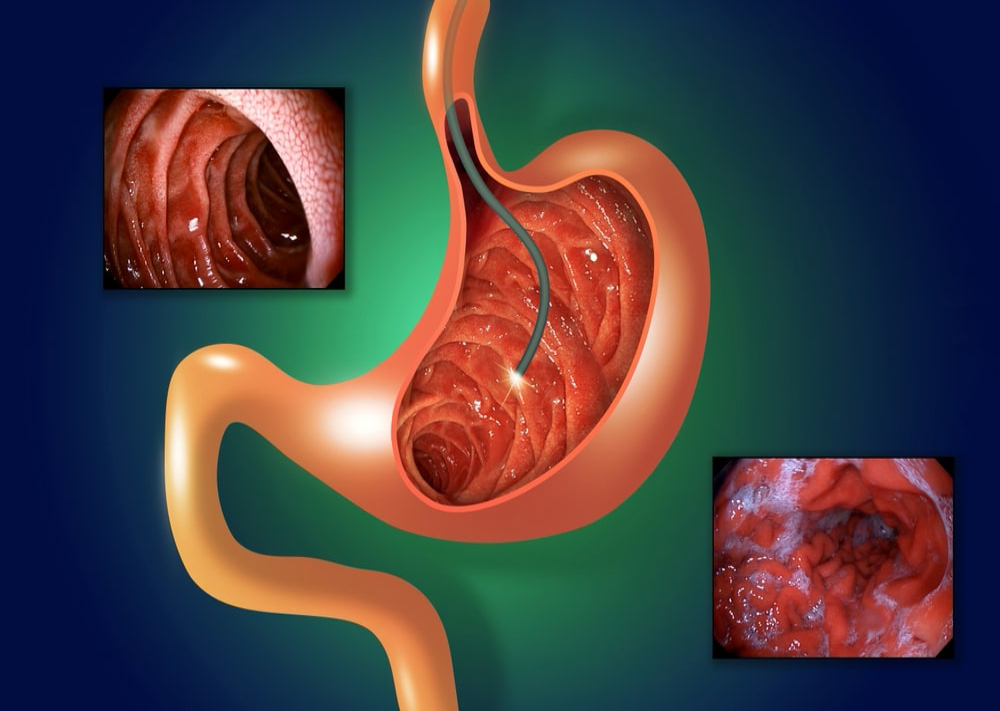 Endoscopy